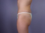 Tummy Tuck Before and after photo