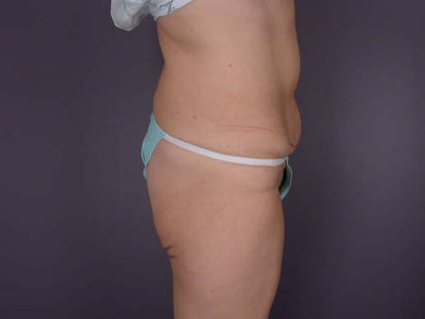 Tummy Tuck before and after photo