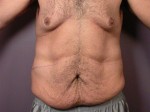 Tummy Tuck Before and after photo