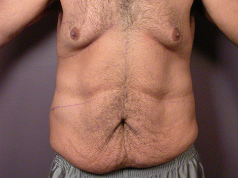 Tummy Tuck before and after photo