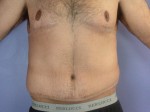 Tummy Tuck Before and after photo