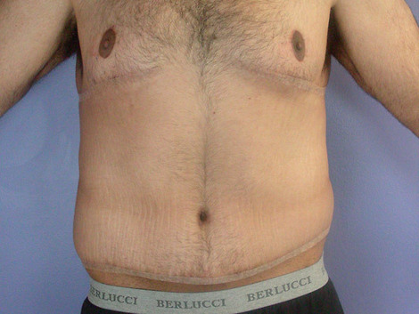 Tummy Tuck before and after photo