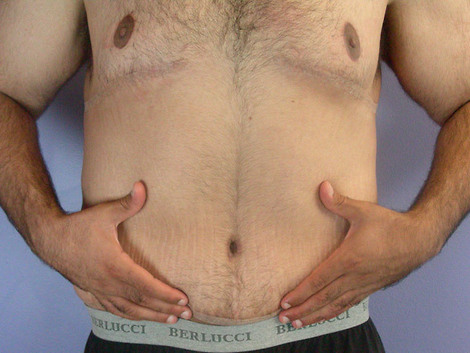 Tummy Tuck before and after photo