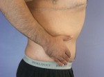 Tummy Tuck Before and after photo