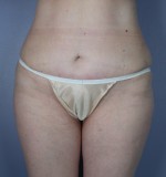 Tummy Tuck Before and after photo