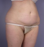 Tummy Tuck Before and after photo