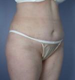 Tummy Tuck Before and after photo