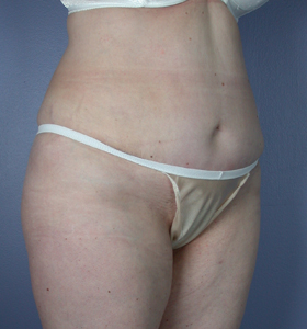 Tummy Tuck before and after photo