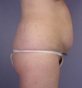 Tummy Tuck before and after photo