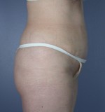 Tummy Tuck Before and after photo