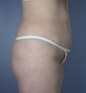 Tummy Tuck before and after photo