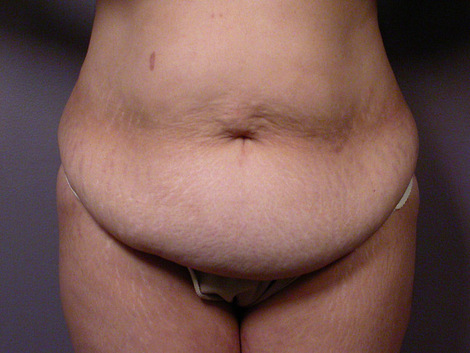 Tummy Tuck before and after photo