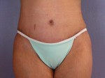 Tummy Tuck Before and after photo