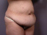 Tummy Tuck Before and after photo