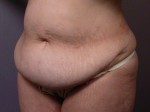 Tummy Tuck Before and after photo