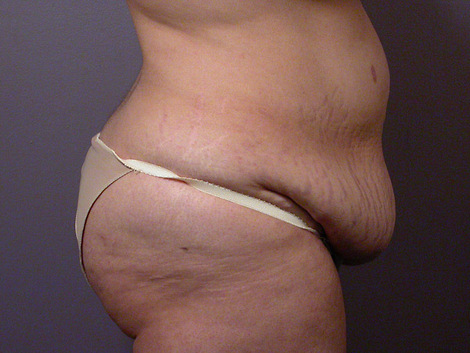 Tummy Tuck before and after photo