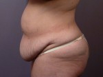 Tummy Tuck Before and after photo