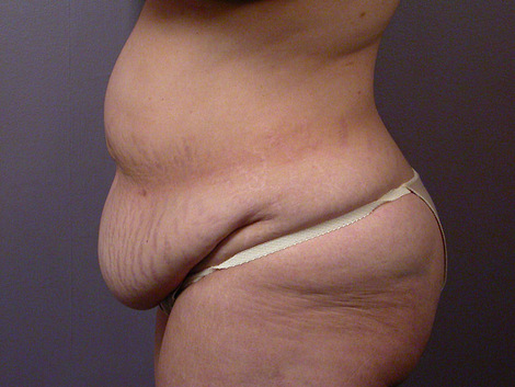 Tummy Tuck before and after photo