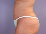 Tummy Tuck Before and after photo