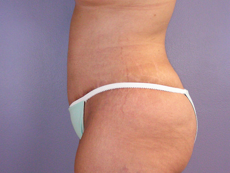 Tummy Tuck before and after photo