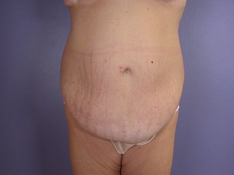 Tummy Tuck before and after photo