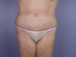 Tummy Tuck