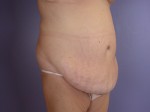 Tummy Tuck