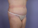 Tummy Tuck Before and after photo