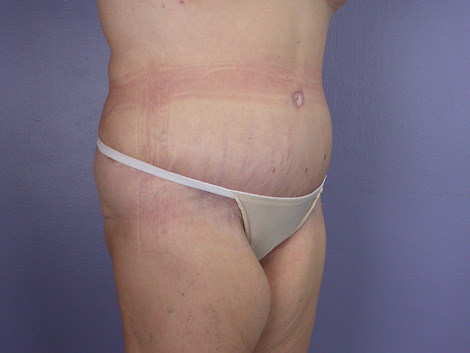 Tummy Tuck before and after photo