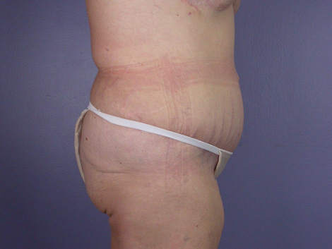 Tummy Tuck before and after photo