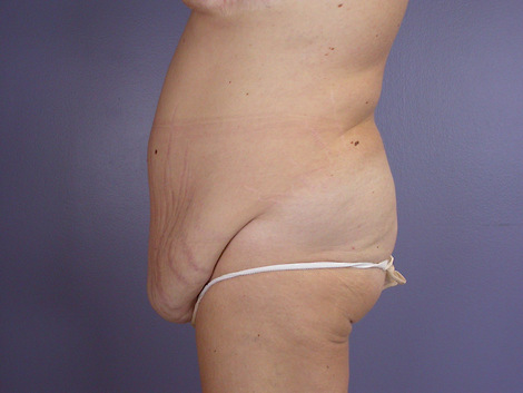 Tummy Tuck before and after photo