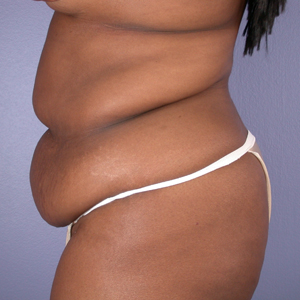 Tummy Tuck before and after photo