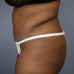 Tummy Tuck Before and after photo