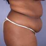 Tummy Tuck Before and after photo