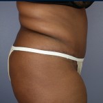 Tummy Tuck Before and after photo