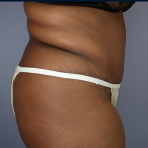 Tummy Tuck before and after photo