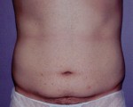 Tummy Tuck