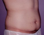 Tummy Tuck Before and after photo