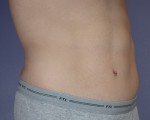 Tummy Tuck Before and after photo