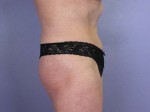 Tummy Tuck Before and after photo