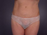 Tummy Tuck Before and after photo