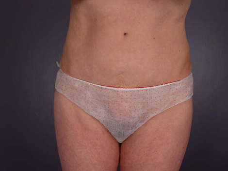 Tummy Tuck before and after photo