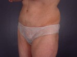 Tummy Tuck Before and after photo