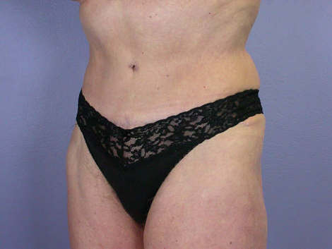 Tummy Tuck before and after photo