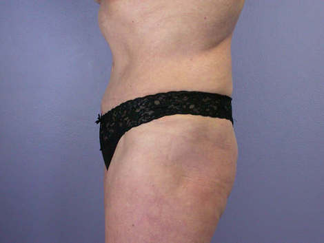 Tummy Tuck before and after photo