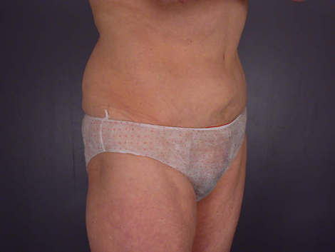 Tummy Tuck before and after photo