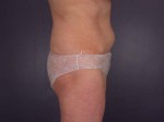 Tummy Tuck Before and after photo