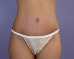 Tummy Tuck Before and after photo