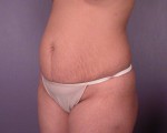 Tummy Tuck Before and after photo