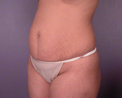 Tummy Tuck before and after photo